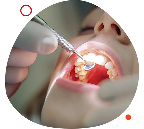 Close-up of a dentist examining a young patient's teeth using a dental mirror and probe, showcasing a routine dental checkup for children's oral health
